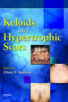 Keloids and hypertrophic scars