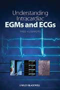 Understanding intracardiac EGMs and ECGs